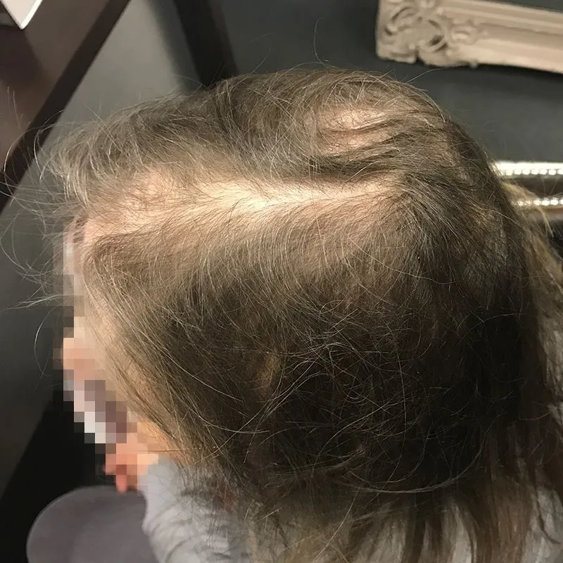Client 01 before laser hair growth therapy