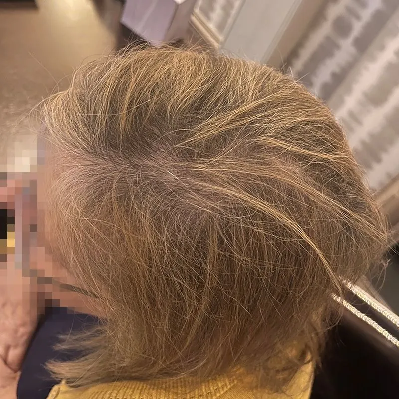 Client 01 after laser hair growth therapy