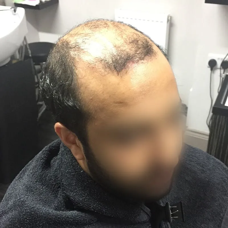 Client 04 before their hair system