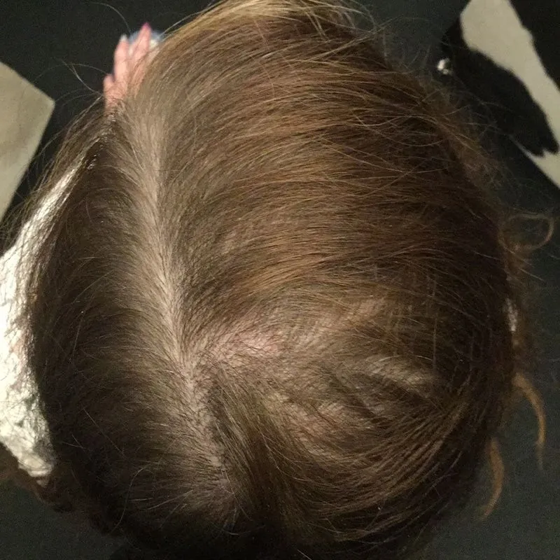 Client 02 before laser hair growth therapy