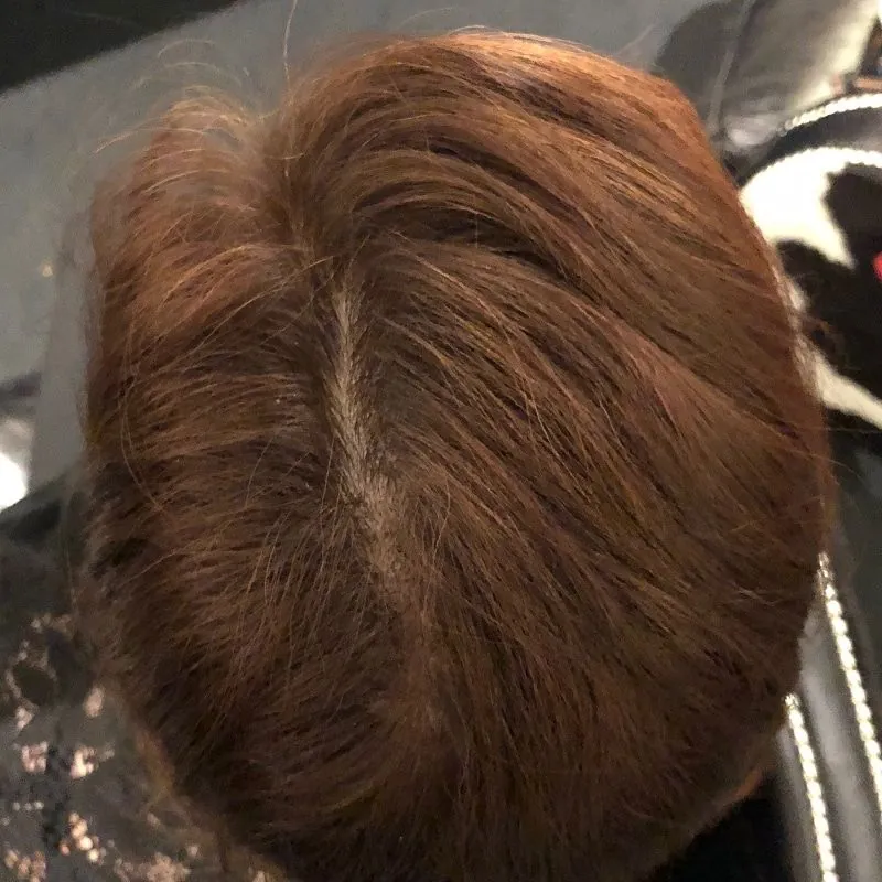 Client 02 after laser hair growth therapy