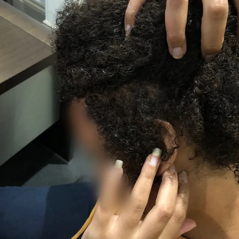 Client 03 after laser hair growth therapy