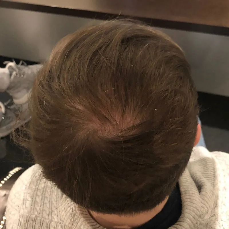 Client 06 after laser hair growth therapy