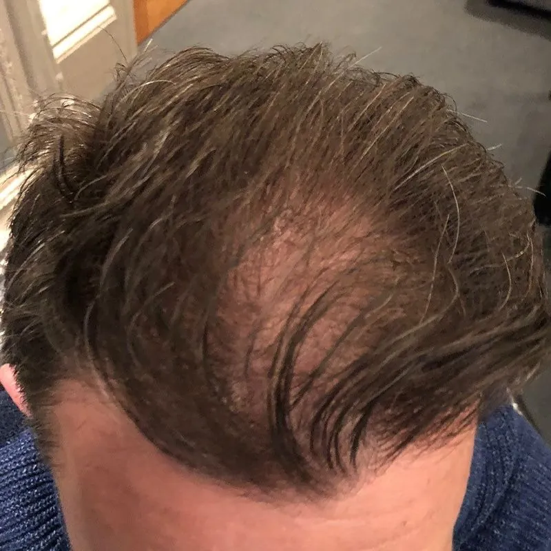 Client 05 before laser hair growth therapy
