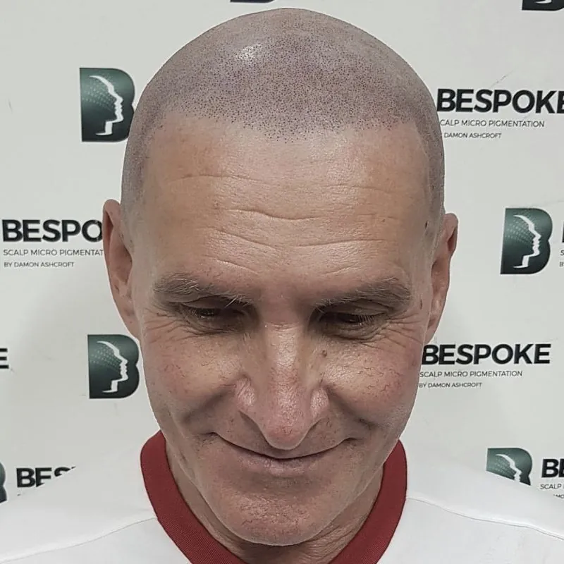 Client 05 after scalp micropigmentation