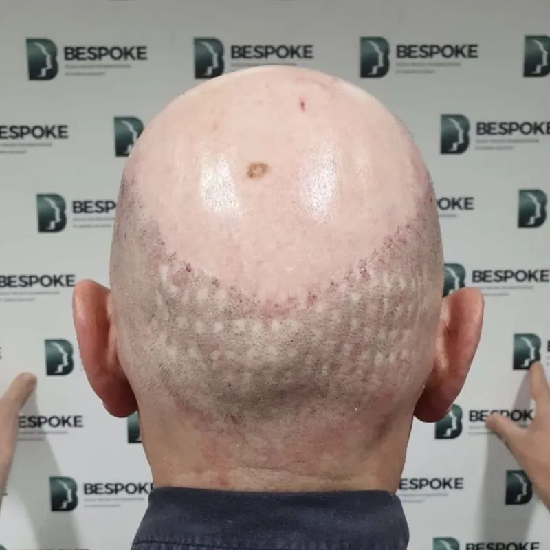 Client 04 before scalp micropigmentation