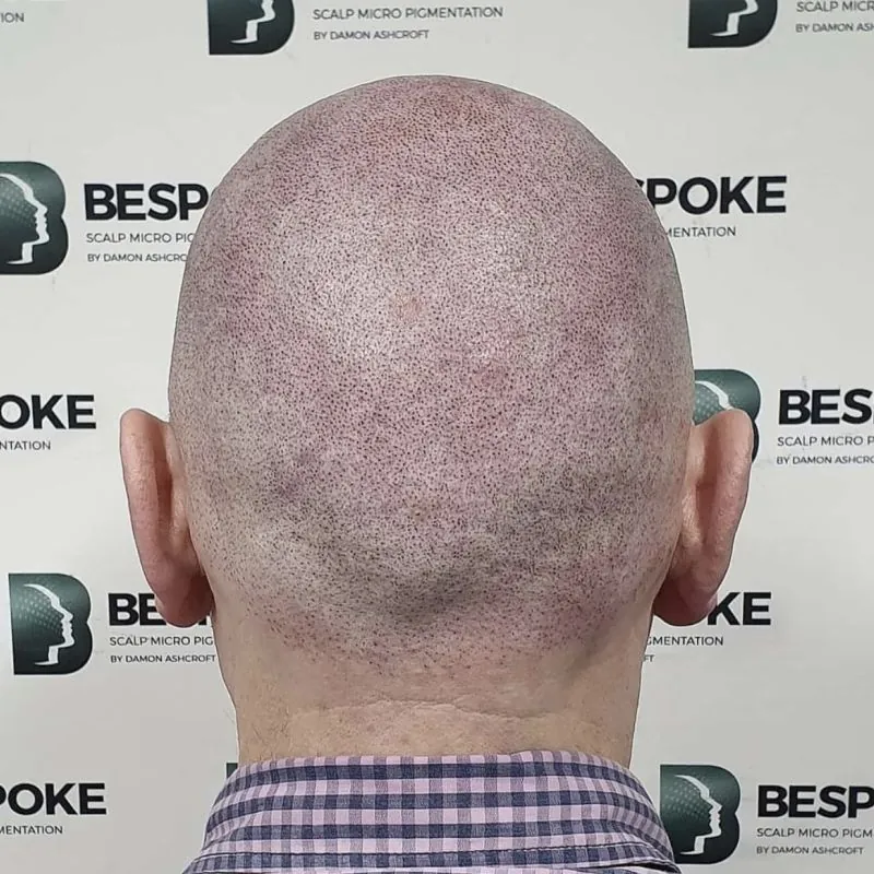 Client 04 after scalp micropigmentation