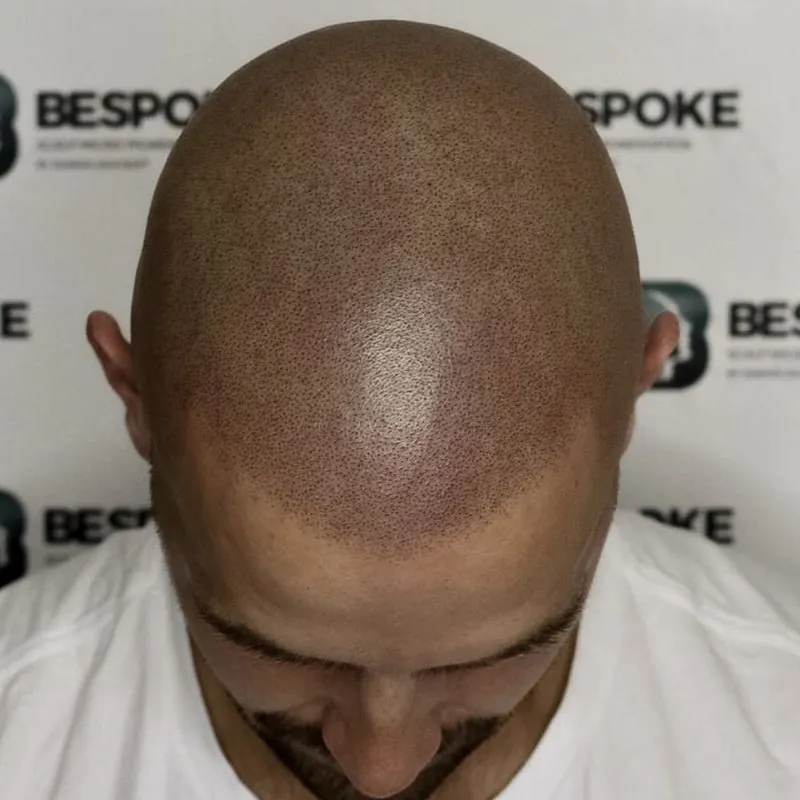 Client 01 after scalp micropigmentation