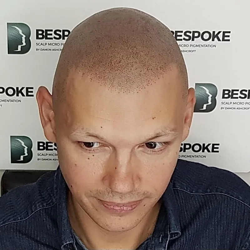 Client 03 after scalp micropigmentation