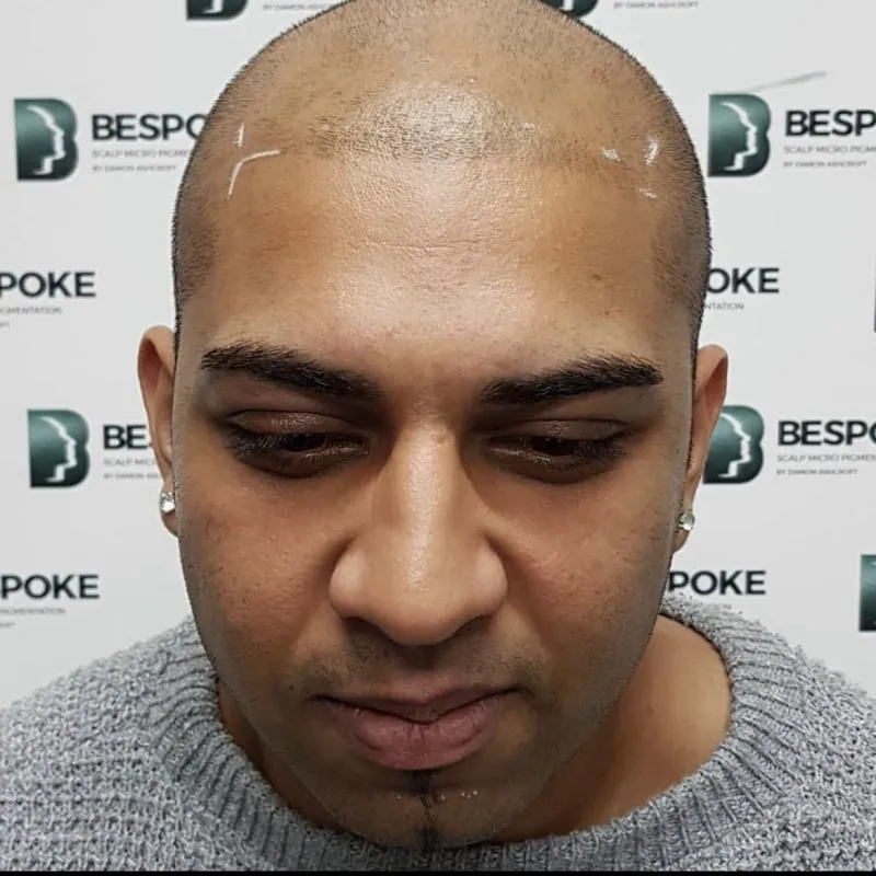Client 06 before scalp micropigmentation